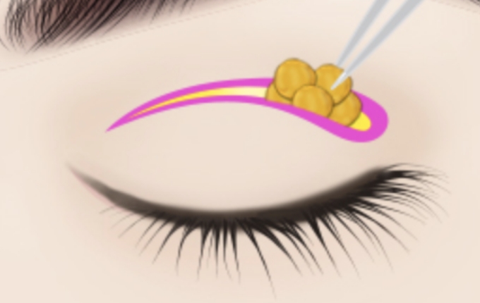 remove excess skin from drooping eyelids