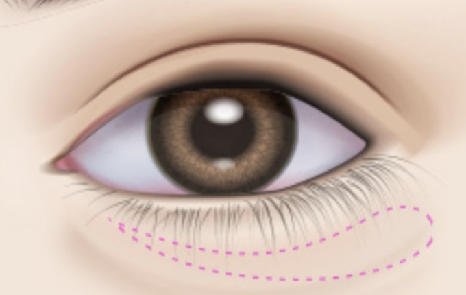examine the face and under-eye area before designing