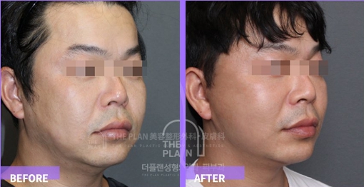 before and after (incision lift)