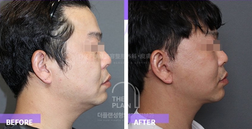 before and after (incision lift)