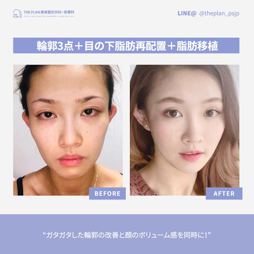 before and after (3-point facial contouring, fat transfer, lower eyelid fat repositioning)