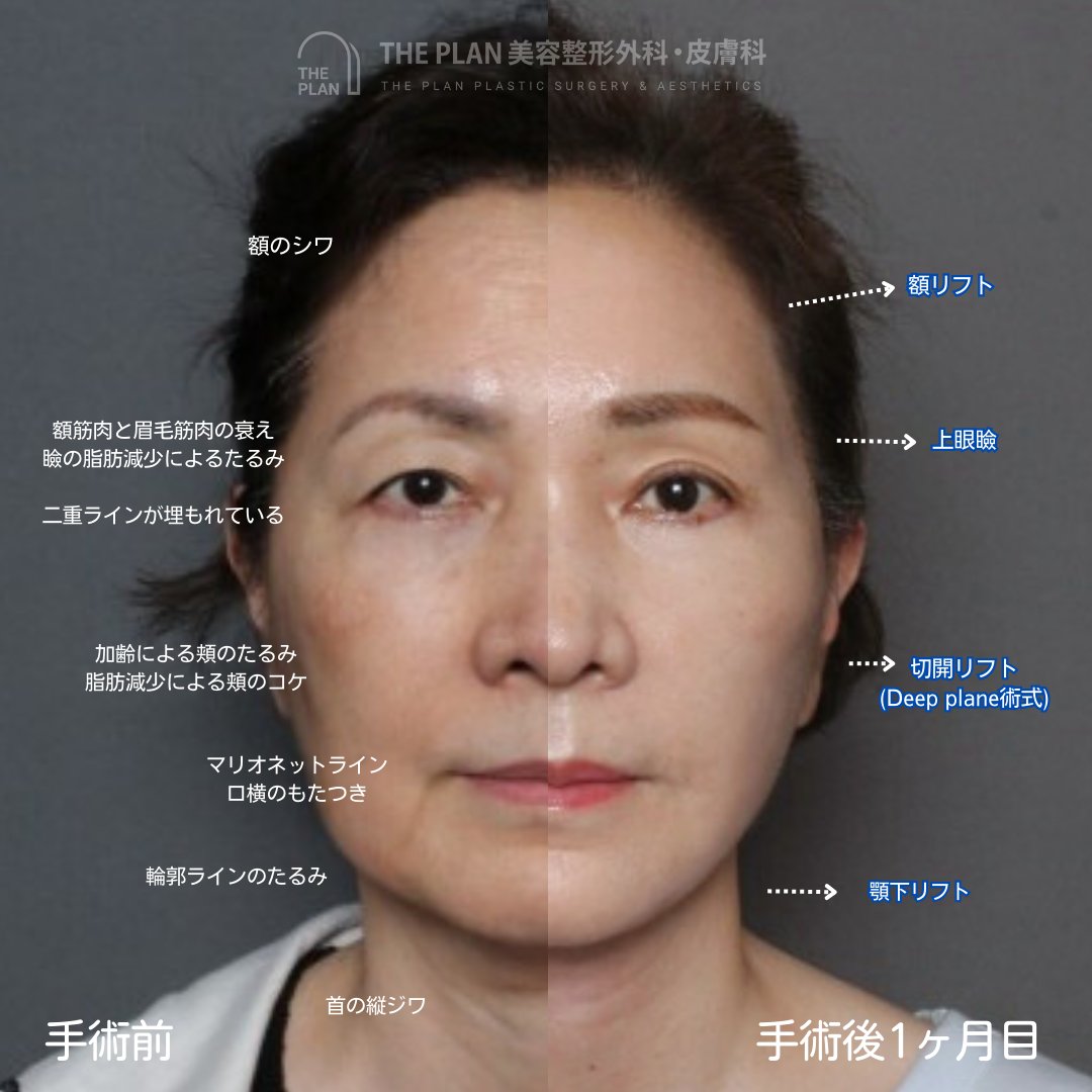 THE PLAN美容整形外科での50代女性フェイスリフト症例。左側の手術前と右側の術後1ヶ月を比較し、額のシワ、瞼のたるみ、マリオネットライン、首の縦ジワの改善効果を解説した写真