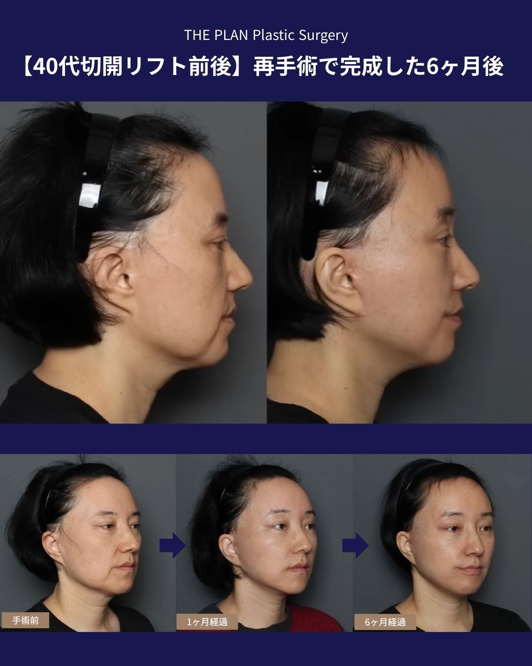 【40代切開リフト前後】再手術で完成した6ヶ月後、頬のたるみと顎ラインの劇的な変化（額リフト＋脂肪移植） 概要: 40代女性のフェイスリフト再手術、額リフト、脂肪移植の症例写真。 詳細: 上段には横顔の比較（Before/After）、下段には左斜め前方からの経過（手術前、1ヶ月経過、6ヶ月経過）を並べた構成。 変化のポイント: 術前は頬のたるみ（マリオネットライン周辺）と二重あごが目立つが、6ヶ月後にはフェイスラインがシャープに引き締まり、額リフトと脂肪移植によって顔全体に若々しいハリが出ている様子が示されている。 テキスト情報: 「THE PLAN Plastic Surgery」「【40代切開リフト前後】再手術で完成した6ヶ月後」「手術前」「1ヶ月経過」「6ヶ月経過」の文字。