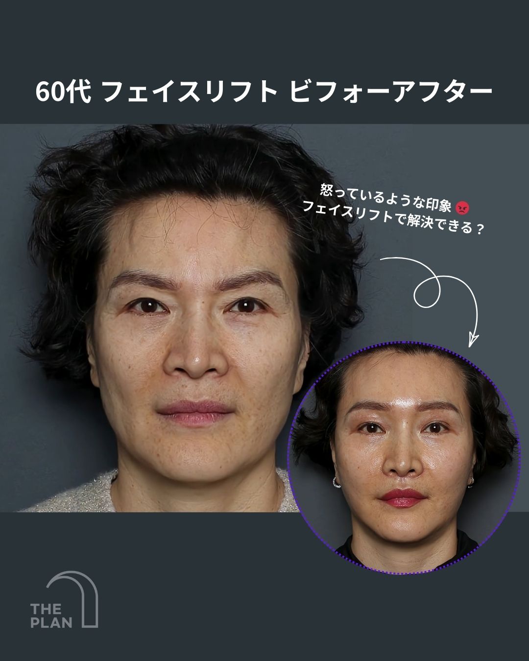 60代女性のフェイスリフト手術ビフォーアフター比較写真。「怒っているような印象はフェイスリフトで解決できる？」というキャッチコピーと共に、術前の無表情な顔と、術後の若々しく明るい表情（円形写真）が配置されている。THE PLAN美容整形外科のロゴ入り。