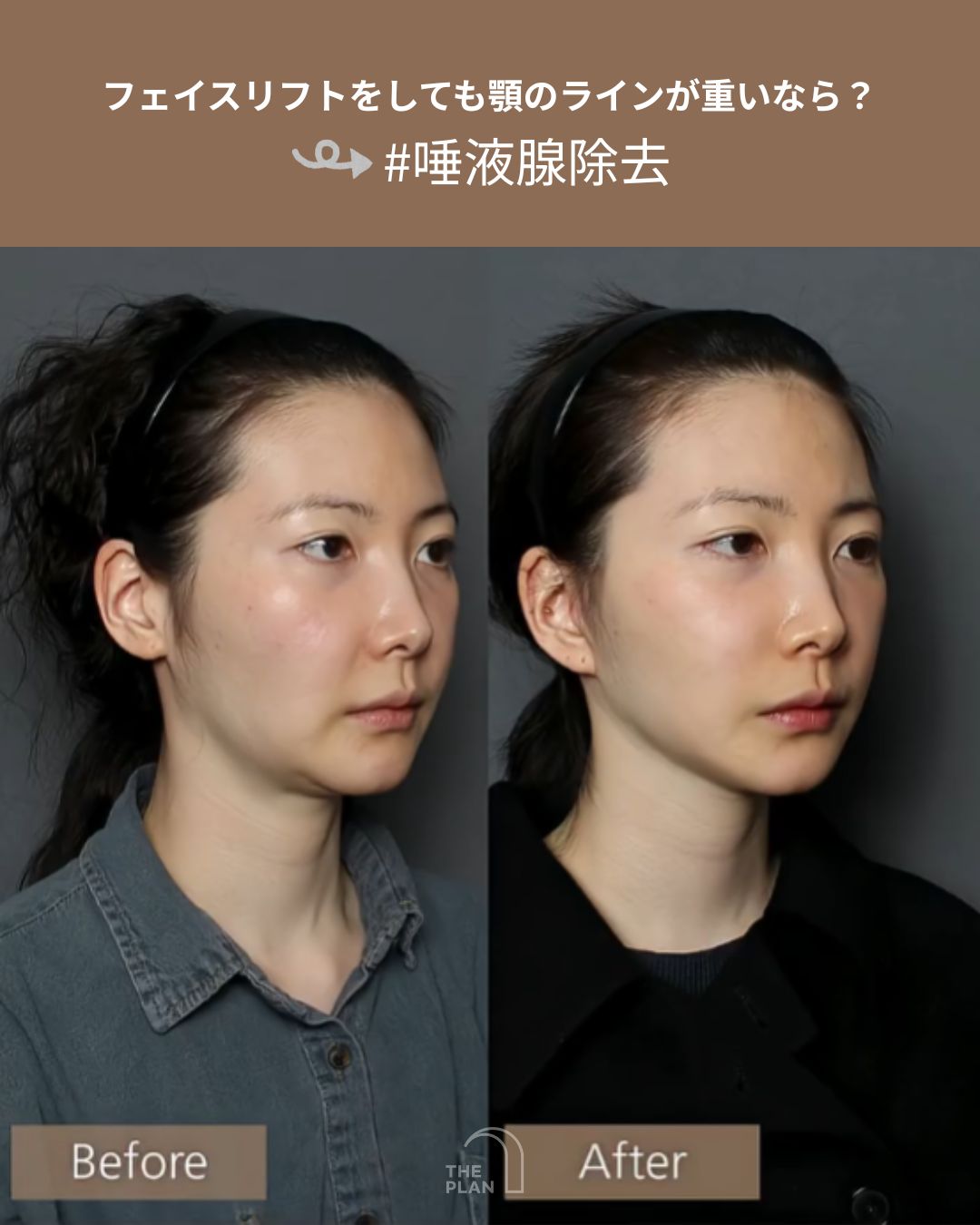 フェイスリフトと唾液腺除去（縮小）の併用手術による、顔の正面および斜め横からのビフォーアフター比較写真。上部には「フェイスリフトをしても顎のラインが重いなら？ #唾液腺除去」という日本語のキャプションがある。術後の写真では、フェイスラインが引き締まり、顎下の重みが解消されてシャープな印象になっている。