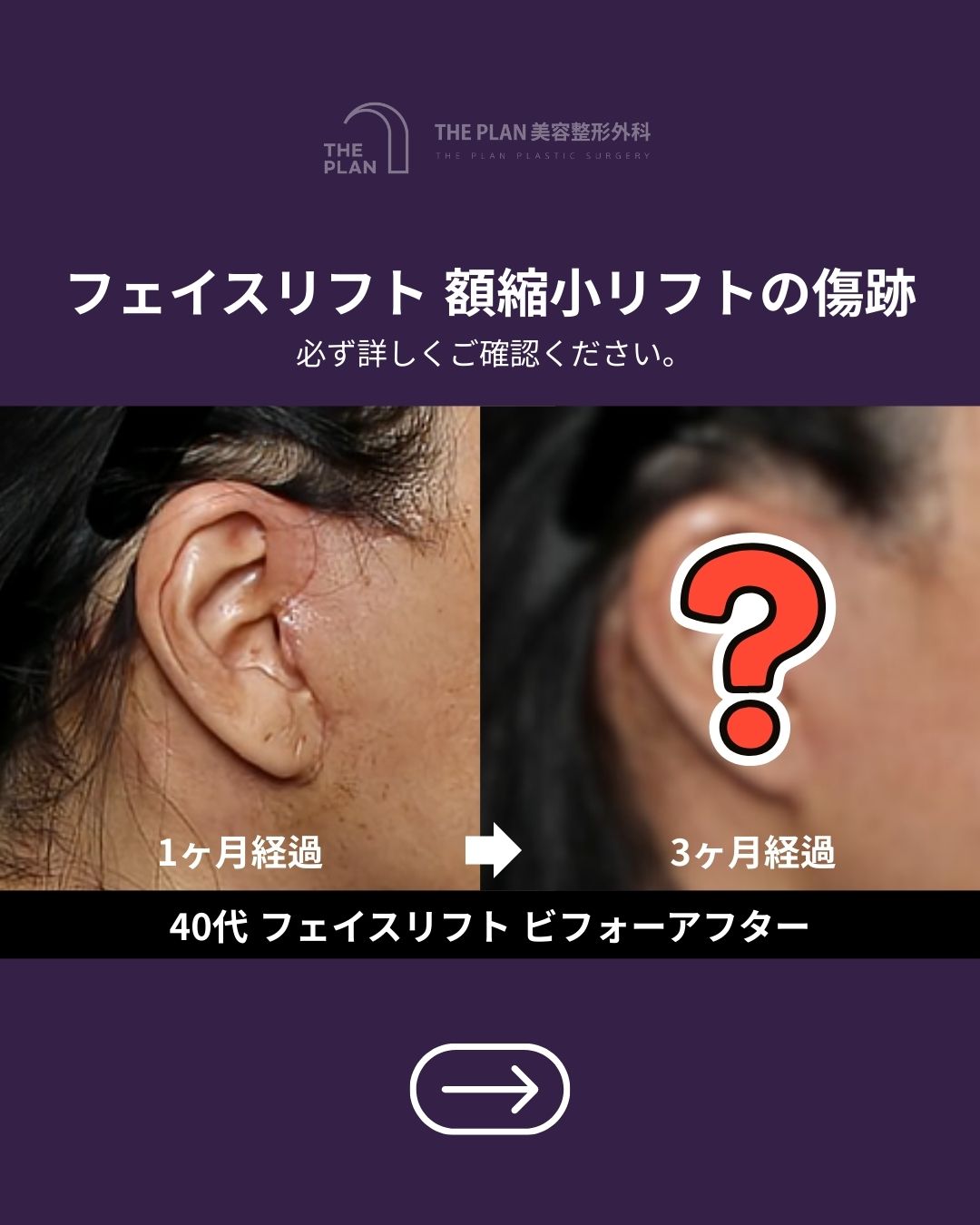 THE PLAN美容整形外科のフェイスリフト・額縮小リフトの傷跡経過写真。左側は術後1ヶ月の状態、右側は術後3ヶ月の状態（結果はクエスチョンマークで隠されています）を示しており、傷跡の回復過程を比較する40代女性の症例画像です。