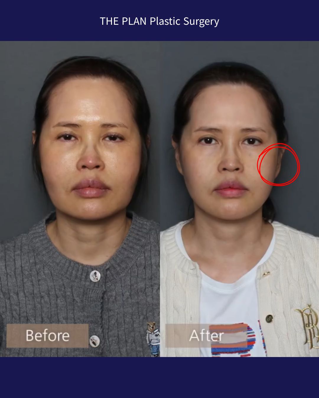 THE PLAN Plastic Surgery（ザ・プラン美容外科）の施術前と施術後の比較写真（正面）。左側が「Before（施術前）」、右側が「After（施術後）」です。Afterの写真では、向かって右側の耳たぶ周辺に赤い丸印が付けられており、耳の形（ピクシーイヤー）に焦点が当てられています。全体的にフェイスラインがすっきりした印象になっています。