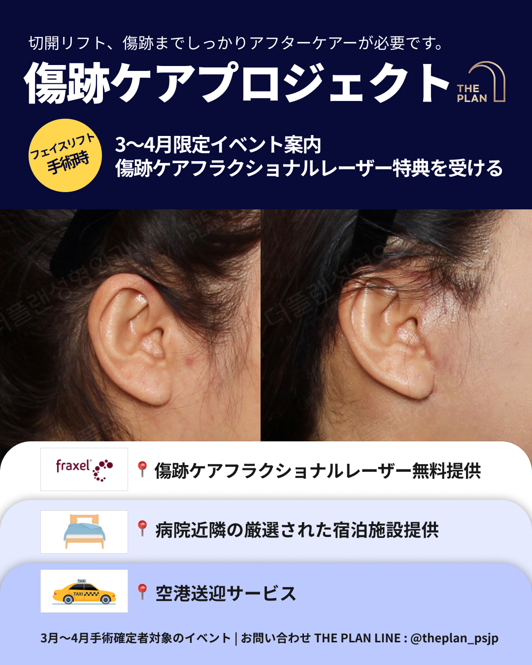 美容外科「THE PLAN」のプロモーション画像。 上部には「切開リフト、傷跡までしっかりアフターケアーが必要です。傷跡ケアプロジェクト」という大きな見出しがあります。その横に「フェイスリフト手術時」という黄色い円形のマークがあり、「3〜4月限定イベント案内 傷跡ケアフラクショナルレーザー特典を受ける」と記載されています。 中央には、切開リフト手術後の耳周辺の傷跡の経過を示す2枚の比較写真が配置されています。 下部には以下の3つの特典がアイコンと共に列挙されています。 ・Fraxel（フラクセル）のロゴと共に「傷跡ケアフラクショナルレーザー無料提供」 ・ベッドのイラストと共に「病院近隣の厳選された宿泊施設提供」 ・タクシーのイラストと共に「空港送迎サービス」 一番下の行には「3月〜4月手術確定者対象のイベント | お問い合わせ THE PLAN LINE : @theplan_psjp」と書かれています。